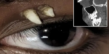 Hindistan'da 16 Yaşındaki Çocuğun Göz Çukurundan Köpek Dişi Çıkarıldı